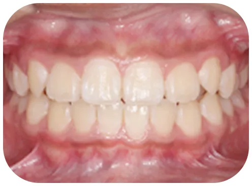 矯正後の写真、正面