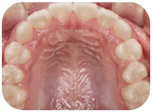 矯正後の写真、上歯