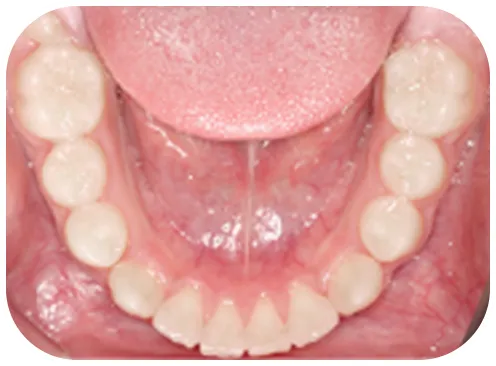 矯正後の写真、下歯