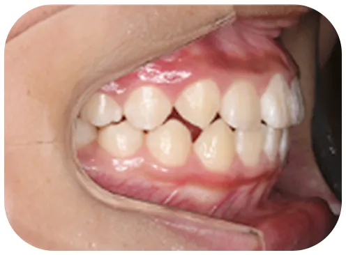 矯正後の写真、横