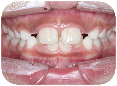 矯正前の写真、正面