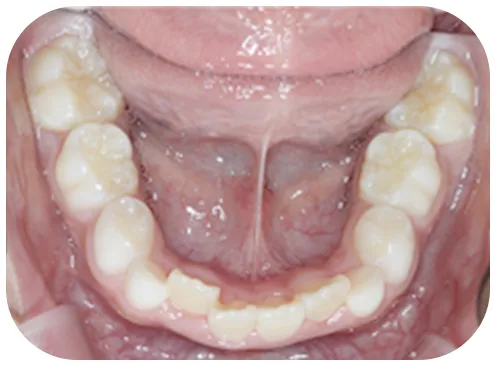 矯正前の写真、下歯
