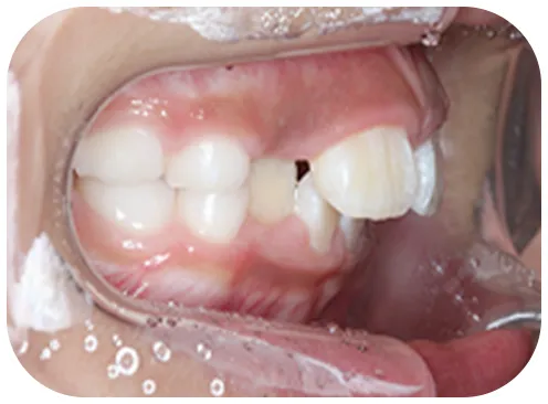 矯正前の写真、横