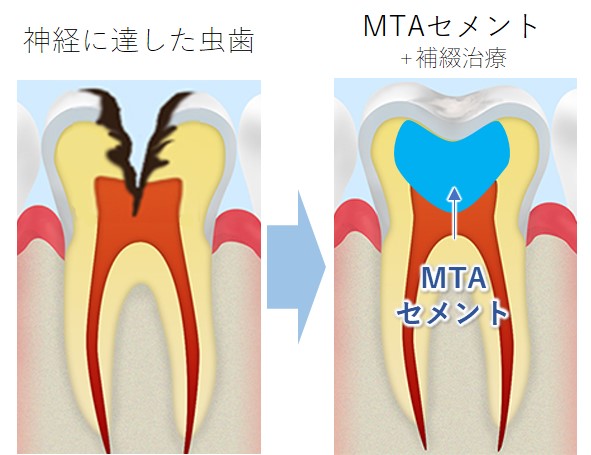 福岡市東区名島の歯医者、徳永歯科こども歯科のMTAセメント