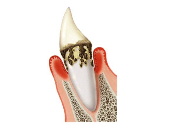 歯周病